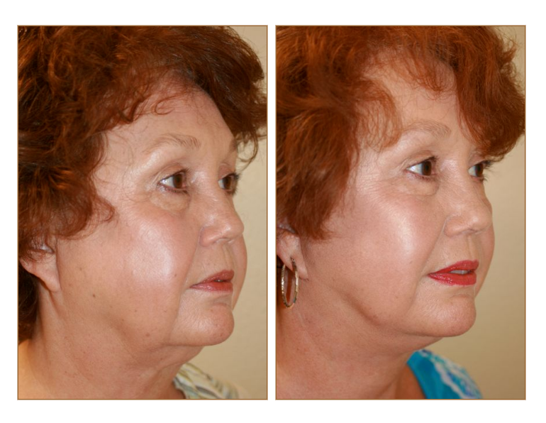 Face Lift Picture Gallery Christopher T Johnson Dmd Facs